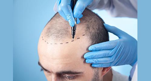 Hair transplant
